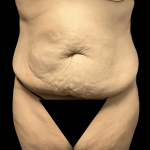 Tummy Tuck Before & After Patient #2870