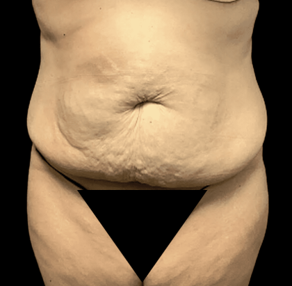 Tummy Tuck Before & After Patient #2870