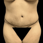 Tummy Tuck Before & After Patient #2870