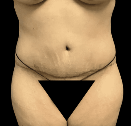 Tummy Tuck Before & After Patient #2870