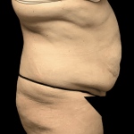 Tummy Tuck Before & After Patient #2870