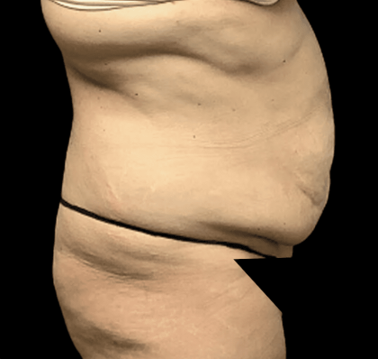 Tummy Tuck Before & After Patient #2870