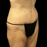 Tummy Tuck Before & After Patient #2875