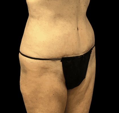 Tummy Tuck Before & After Patient #2875