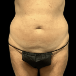 Tummy Tuck Before & After Patient #2875