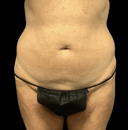 Tummy Tuck Before & After Patient #2875