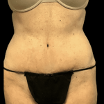 Tummy Tuck Before & After Patient #2875