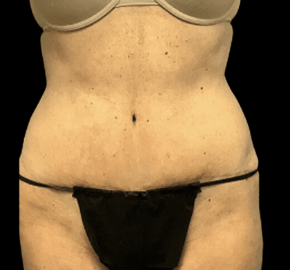 Tummy Tuck Before & After Patient #2875