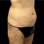 Tummy Tuck Before & After Patient #2875