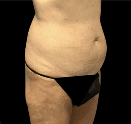 Tummy Tuck Before & After Patient #2875
