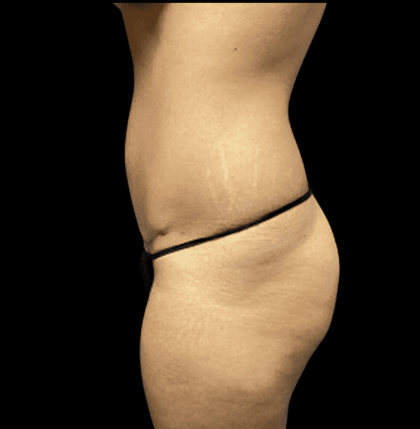 Tummy Tuck Before & After Patient #2880