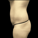 Tummy Tuck Before & After Patient #2880
