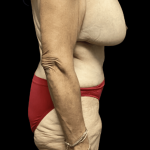 Tummy Tuck Before & After Patient #2885