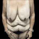 Tummy Tuck Before & After Patient #2885