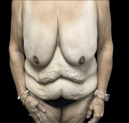 Tummy Tuck Before & After Patient #2885