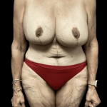 Tummy Tuck Before & After Patient #2885