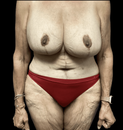 Tummy Tuck Before & After Patient #2885