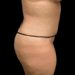 Tummy Tuck Before & After Patient #2890
