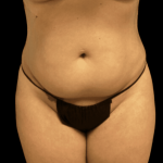 Tummy Tuck Before & After Patient #2890