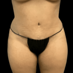 Tummy Tuck Before & After Patient #2890