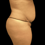 Tummy Tuck Before & After Patient #2890