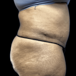 Tummy Tuck Before & After Patient #2895