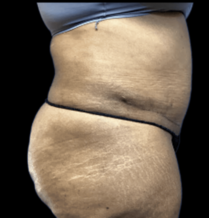 Tummy Tuck Before & After Patient #2895