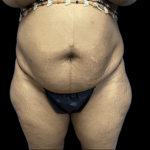 Tummy Tuck Before & After Patient #2895