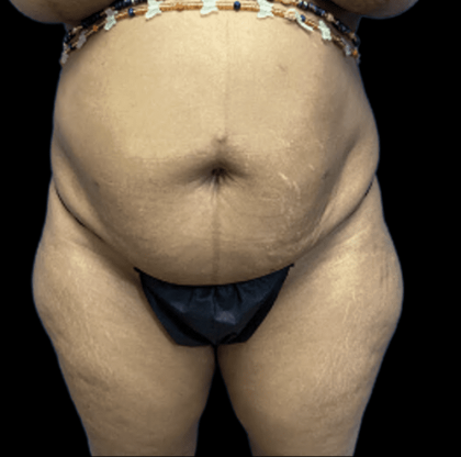 Tummy Tuck Before & After Patient #2895