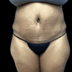 Tummy Tuck Before & After Patient #2895