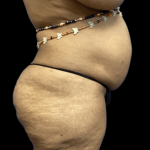 Tummy Tuck Before & After Patient #2895