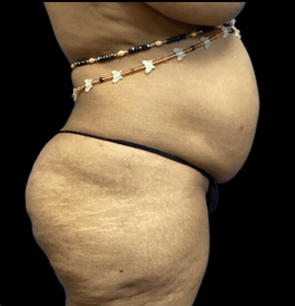 Tummy Tuck Before & After Patient #2895