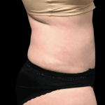 Tummy Tuck Before & After Patient #2900