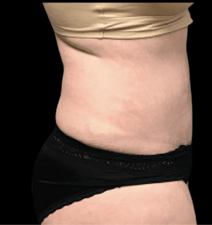 Tummy Tuck Before & After Patient #2900