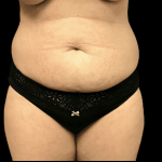 Tummy Tuck Before & After Patient #2900