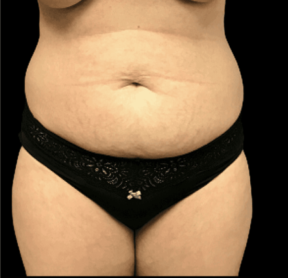 Tummy Tuck Before & After Patient #2900