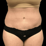Tummy Tuck Before & After Patient #2900