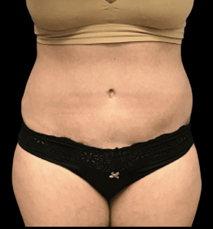 Tummy Tuck Before & After Patient #2900