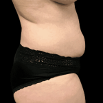 Tummy Tuck Before & After Patient #2900