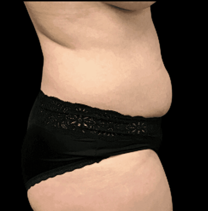 Tummy Tuck Before & After Patient #2900