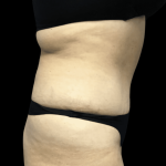 Tummy Tuck Before & After Patient #2905