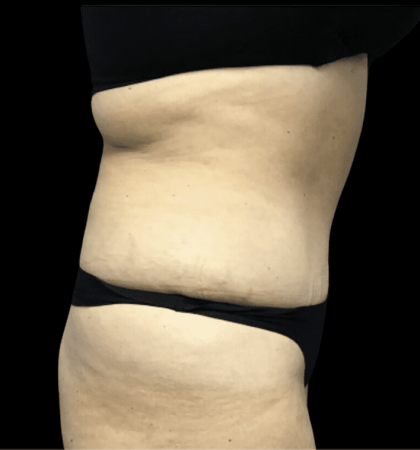 Tummy Tuck Before & After Patient #2905