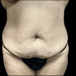 Tummy Tuck Before & After Patient #2905