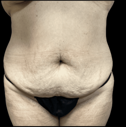 Tummy Tuck Before & After Patient #2905