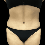 Tummy Tuck Before & After Patient #2905