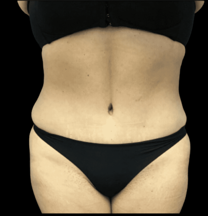 Tummy Tuck Before & After Patient #2905
