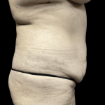 Tummy Tuck Before & After Patient #2905