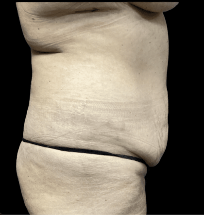 Tummy Tuck Before & After Patient #2905