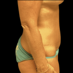 Tummy Tuck Before & After Patient #2910