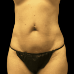 Tummy Tuck Before & After Patient #2910